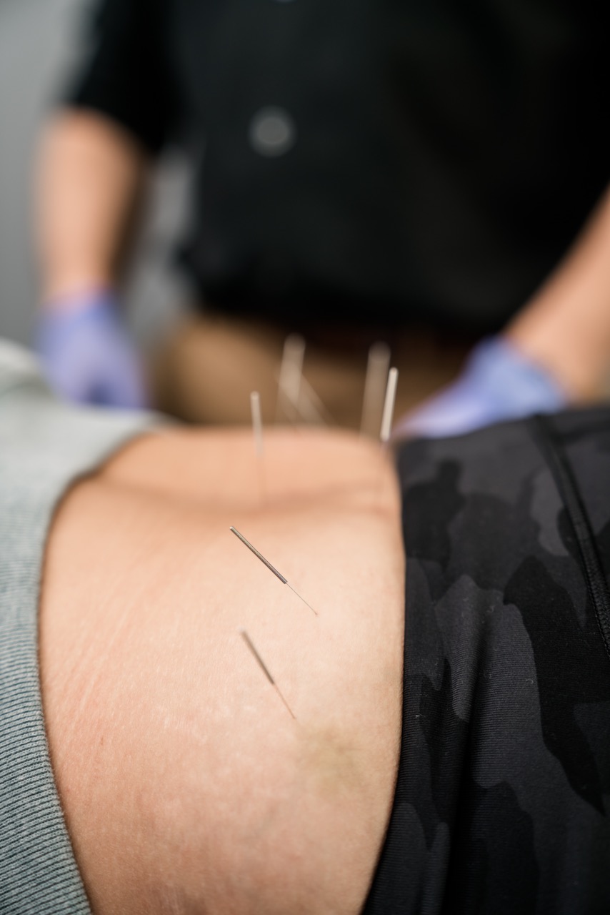 Integrative dry needling treatment at BeWell Physical Therapy